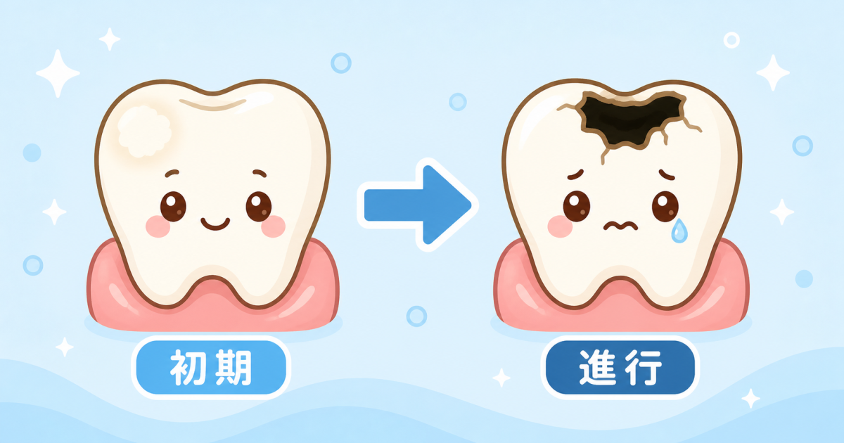 ■乳歯のむし歯は初期と進行でどう違う?黒い変色・穴が開く段階別の症状